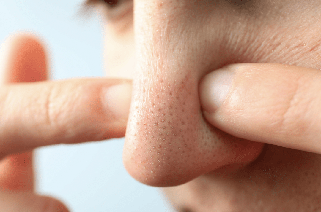 お肌の辛い毛穴トラブル…間違えたケアはトラブルを増やす原因に！？